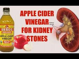 Youtube Treat Kidney Stones Kidney Stones Apple Cider Vinegar