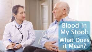 Colon cancer is sometimes called colorectal cancer, which is a term that combines colon cancer and rectal cancer, which begins in the rectum. Blood In Stool What Does It Mean