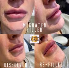 Patient 162335309 | Lip Fillers Before & After Photos | Dr. Courtney  Plastic Surgery