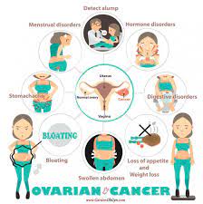 In most cases, ovarian cancer isn't diagnosed until it's progressed to an advanced stage. Ovarian Cancer The Importance Of Recognizing The Symptoms Garden Ob Gyn Obstetrics