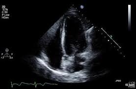 Clinical echocardiography enables you to use echocardiography to its fullest potential in your initial diagnosis, decision making, and clinical management of patients with a wide range of heart diseases. What Is The Role Of Echocardiography In The Diagnosis Of Takotsubo Stress Cardiomyopathy Broken Heart Syndrome