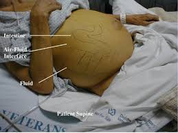 Image result for Shifting Dullness Test