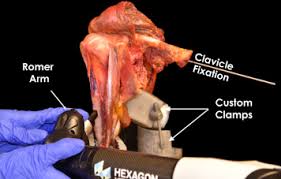 We did not find results for: Quantitative Assessment Of The Coracoacromial And The Coracoclavicular Ligaments With 3 Dimensional Mapping Of The Coracoid Process Anatomy A Cadaveric Study Of Surgically Relevant Structures Arthroscopy
