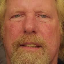 Fundraiser by Bruce Minter : HELP: Advanced BCC Cancer Treatment