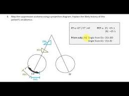 Hess Chart Interpretation By Connie Koklanis