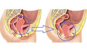 Sebenarnya, tanda rahim jatuh ini boleh dikesan sendiri dari rumah dan anda boleh ikut 3 duduk bercangkung, kemudian masukkan jari dalam vagina. Para Wanita Harus Tau Inilah Gejala Dan Tanda Rahim Turun Setelah Melahirkan Resep Masakan Tips Sehat