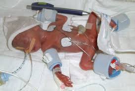 Es ist schwer, zahlen darüber zu finden, aber soweit ich weiss, liegt die sterblichkeit so früh geborener babies bei ca. Medizinische Besonderheit 300 Gramm Leichtes Baby Uberlebt Ohne Komplikationen Gesundheit Faz