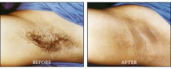 There are many ways to remove armpit hair. Permanent Laser Hair Removal Reduction In Chicago Illinois Advanced Laser Clinics