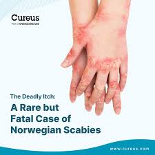 Image result for scabies norvegica