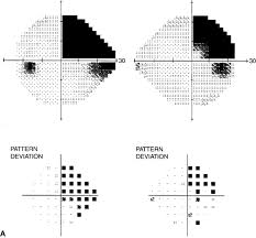 Quadrantanopia An Overview Sciencedirect Topics