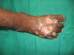Madura foot is caused by a fungus that lives in soil, so is very common among barefoot agricultural workers. Mycetoma Madhura Foot Madhura Mycoses Eumycetoma Eumycotic Mycetoma Maduromycotic Mycetoma Actinomycetoma Actinomycotic Mycetoma Actinomycetic Mycetoma Dermatology Advisor