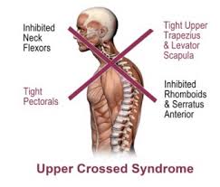 Upper Crossed Syndrome Treatments Symptoms And How To Correct It