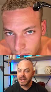 Derma Roller Rossman