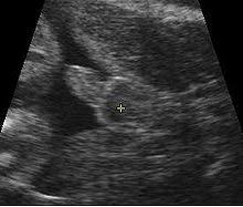 Nak kata tak excited nak tahu tak jugak. Sejauh Mana Ketepatan Ultrasound Mengesan Jantina Dr Zubaidi Hj Ahmad Menulis