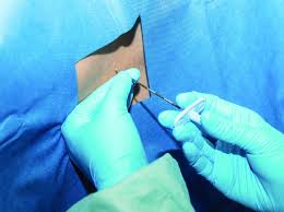 Image result for Active Labor Anesthesia