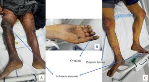 Without a supply of blood, the affected bone and the tissue that surrounds it can gradually begin to die. Terlipressin Induced Ischaemic Skin Necrosis Bmj Case Reports