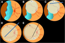 A retinal tear is a small rip or opening that forms in the tissues of the retina. Management Of Giant Retinal Tear With Microincision Vitrectomy And Metallic Retinal Tacks Fixation A Case Report Bmc Ophthalmology Full Text