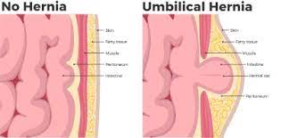 Hernia During Pregnancy And Labor Symptoms Treatment