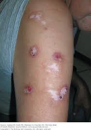 Image result for Neurotic Excoriation