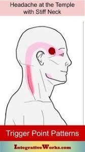 Headache At Your Temple With Stiff Neck Integrative Works In 2020 Stiff Neck Headache Trigger Points