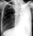 What Causes Atelectasis? - NHLBI, NIH - National Heart, Lung, and
