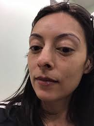 Eating too many donuts causes lip swelling