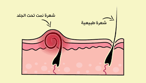 خلطة لازالة الشعر تحت الجلد افضل اجابة