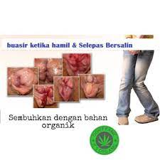 Buasir atau hemoroid merupakan bengkakkan pada vena yang terletak di bahagian rektum dan dubur. Minyak Buasir Hemorrhoids Oil By Hemcare Sakit Organik Hamil No Cream Or Pil Shopee Malaysia