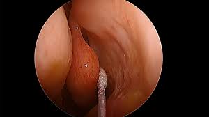 Sinusitis is an inflammation of the sinuses that can cause them to get blocked and filled with fluid. Staph Germs Hide Out In The Hidden Recesses Of Your Nose Shots Health News Npr