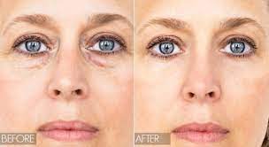 Hilangkan eyebag serta merta, hilangkan mata panda, hilangkan garis halus bawah mata, hilangkan kedutan bawah mata. Petua Semulajadi Hilangkan Eye Bag Dan Mata Panda 11 Cara Hilangkan Eye Bag Secara Semulajadi Dalam 30 Minit
