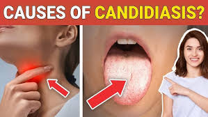 Image result for Candidiasis