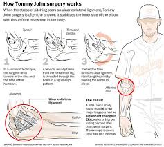 Recipients face a year of strenuous rehabilitation before they. Tommy John Surgery Tommy John Baseball Injuries Baseball Pants