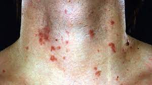 Maybe you would like to learn more about one of these? Phytophotodermatitis Symptoms Causes And More