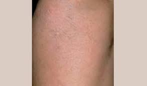 Laser hair removal, laser treatments, peels, botox, dermal fillers, kybella, prp. Lightsheer Laser Hair Removal Treatments Permanent Laser Hair Reduction Aesthetipedia Com