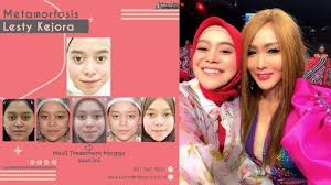 Wajah Awal Hingga Akhir Lesti Kejora Setelah Botox Dan Tanam Benang Inul Daratista Beri Respons Tribun Medan wajah awal hingga akhir lesti kejora