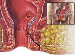 الناسور الشرجي أسبابه وطرق علاجه ومضاعفاته المرأة والصحة الصباح العربي