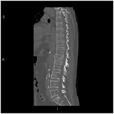 Image result for Vertebral Compression Fracture