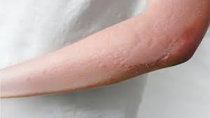 Check spelling or type a new query. Penyebab Dan Jenis Jenis Dermatitis Kontak