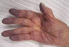 Aug 31, 2018 · what is sepsis? Sepsis Hautzeichen The Mottling Score Marmorierung In Der Sepsis Yema In Diesem Filmbeitrag Von Faszination Wissen Konnt Ihr Sehr Anschaulich Sehen Was Bei Einer Sepsis Passiert Sepsis