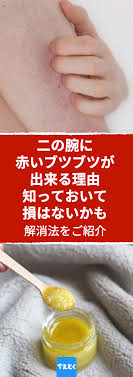 半袖やノースリーブを着る季節 腕をブツブツを気にするあまりちょっぴり憂鬱な気分になることもあるでしょう 思い当たる人は一般的に さめ肌 と呼ばれる皮膚疾患の一つ 毛孔性角化症 毛孔性苔癬 を発症しているかもしれません 健康上重大な問題はありませんが