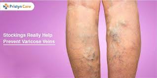 Do Compression Stockings Really Help Prevent Varicose Veins