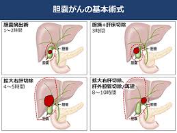 胆道がんの手術と成績 胆道がん がん研有明病院