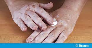 La seule finalité est de devenir un individu au teint clair. Le Vitiligo Quand La Peau Perd Son Pigment Brunet