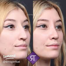 Transformative Rhinoplasty: Before and After Results 👃🏼💫