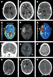 Stroke The Lancet