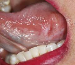 Cancer can cause different symptoms, such as abnormal bumps, night sweats, or unexplained weight gain or loss. Self Oral Cancer Screening Socs Education Program School Of Dentistry Lsu Health New Orleans