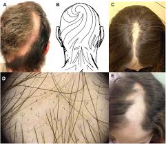 Image result for Alopecia