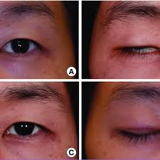 Will gold eyelid weights help? Pdf Upper Eyelid Platinum Weight Placement For The Treatment Of Paralytic Lagophthalmos A New Plane Between The Inner Septum And The Levator Aponeurosis