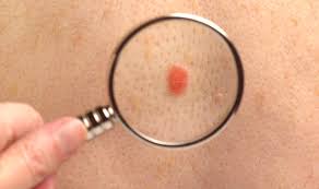 The first two, along with a number of less common skin cancers, are known as nonmelanoma skin cancer (nmsc). 5 Skin Cancer Symptoms You Need To Know This Summer Women Daily Magazine