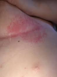 Image result for heat rash under breasts